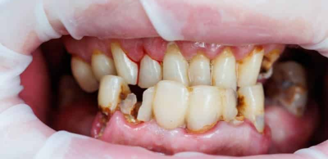 Before whitening